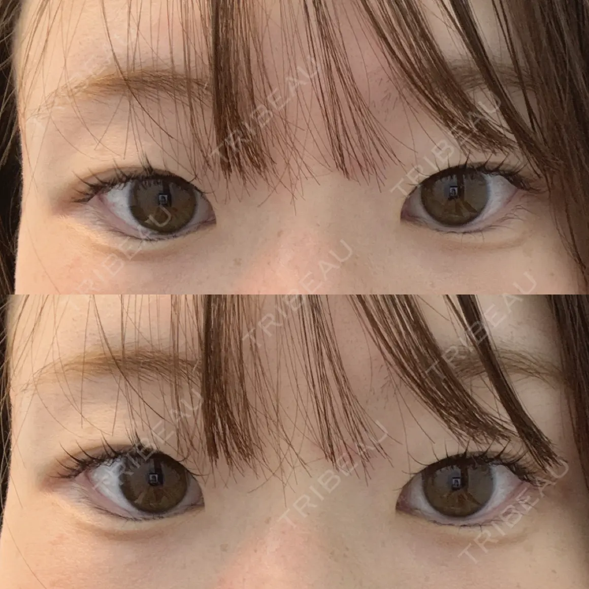 二重埋没 Stand by Beauty Clinic AFTER