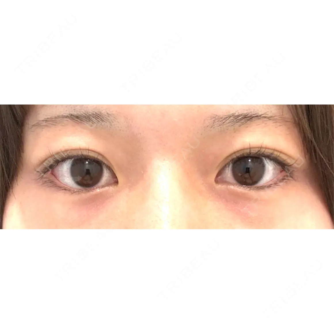 二重埋没 / クマ治療 / 下まぶたたるみ取り / 下まぶたの脂肪取り / 自然癒着法 東京シンデレラ美容外科 大宮院 AFTER