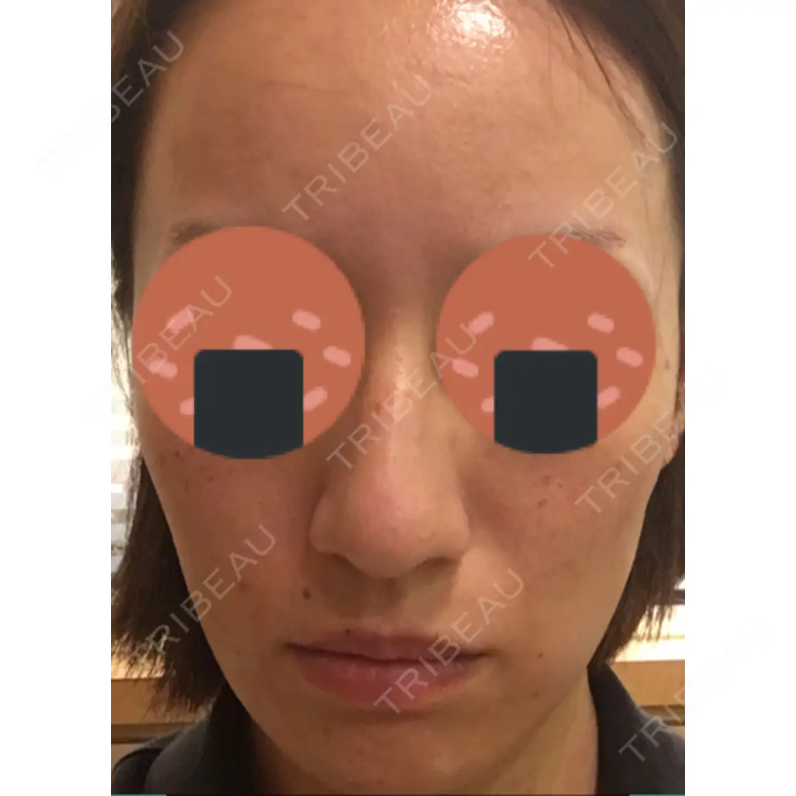 美肌レーザー / シミ取りレーザー / フォトRF 川崎中央クリニック AFTER
