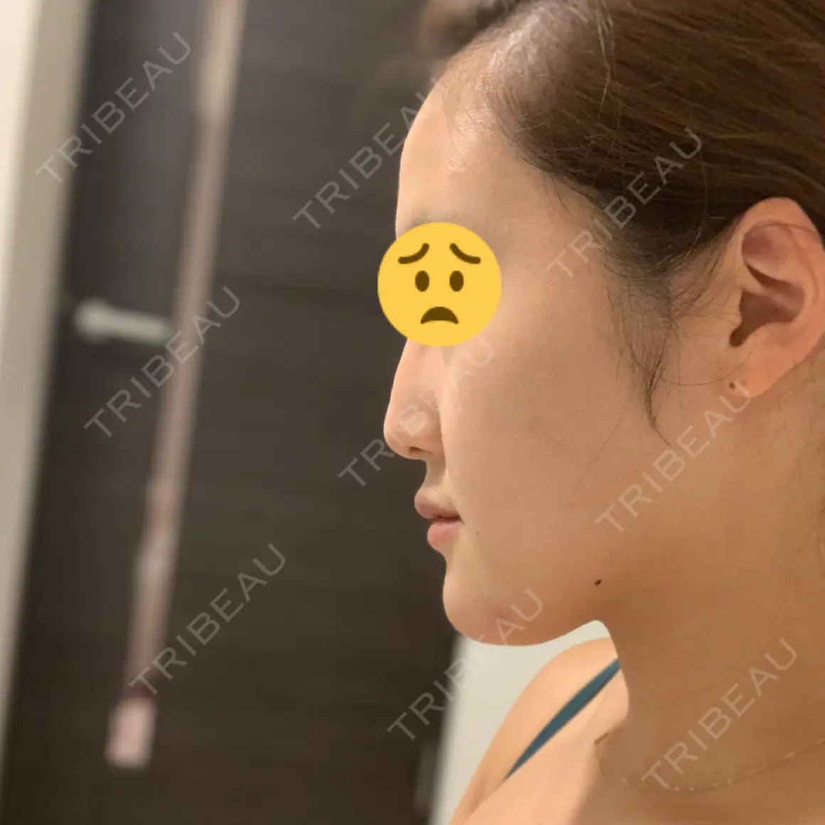 ボトックス（あご） BIANCA銀座 AFTER