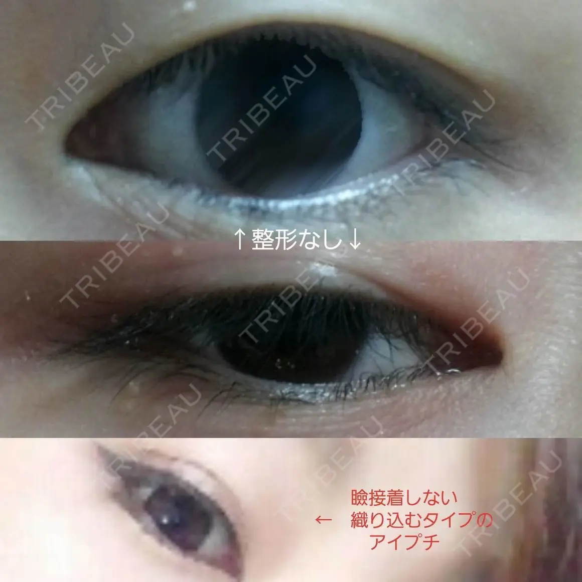 二重切開 高須クリニック 名古屋院 AFTER