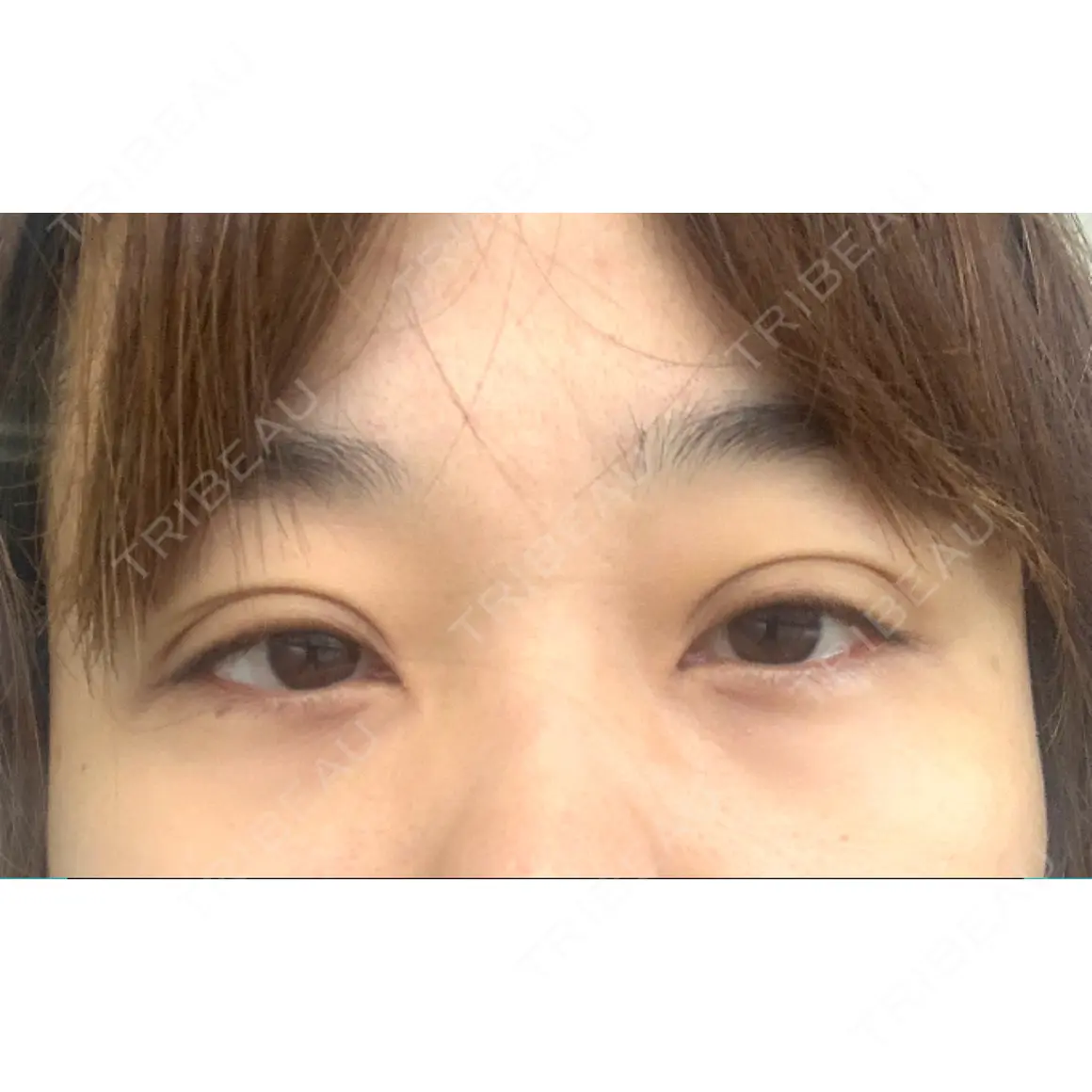 眼瞼下垂（切開） セオリークリニック AFTER