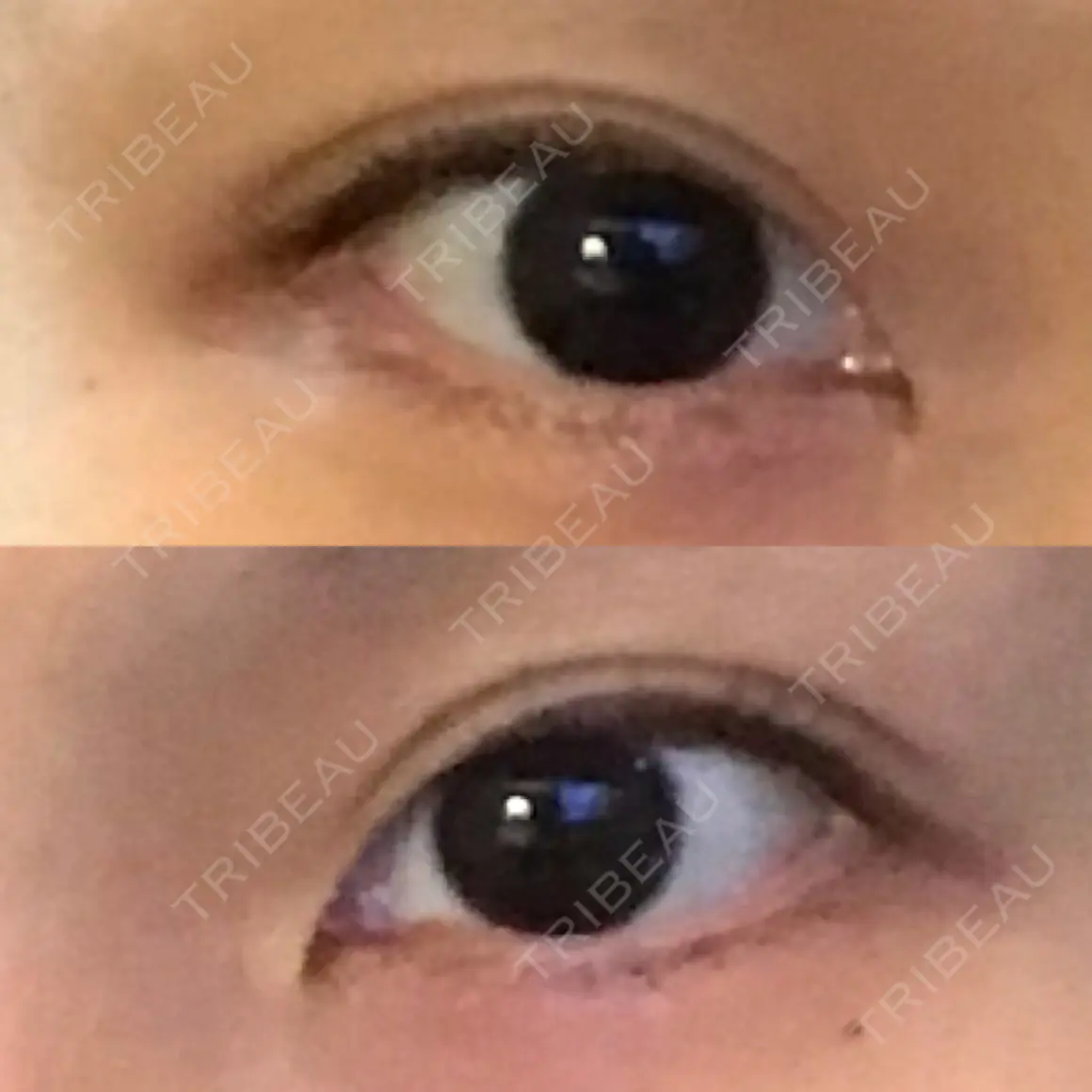 目頭切開 / タレ目形成・グラマラスライン（切開） エートップ美容整形外科 AFTER