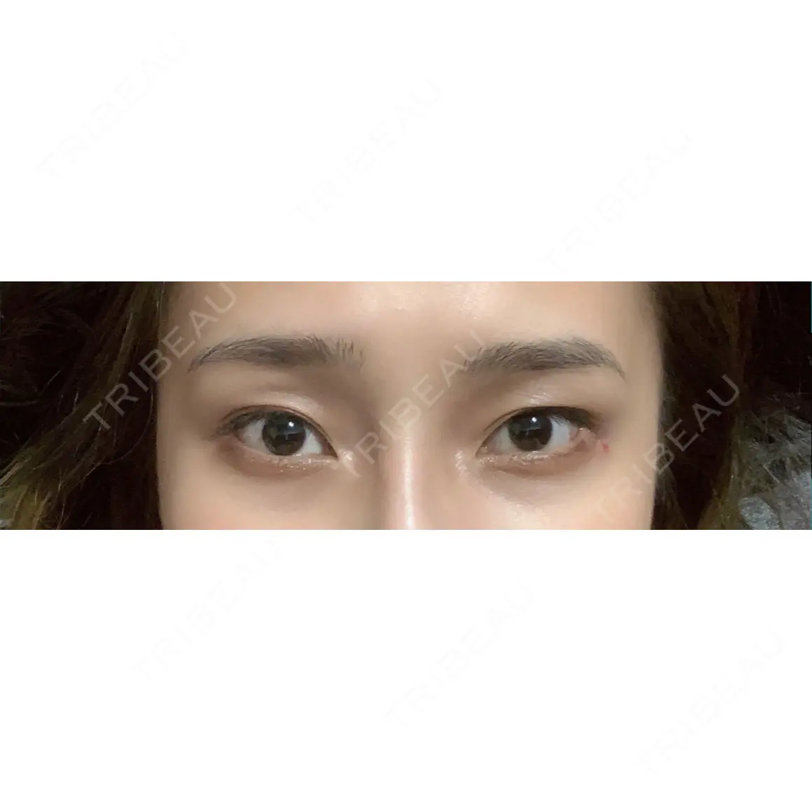 二重切開 / 目頭切開 / 眼瞼下垂（切開） / 目尻切開 / 下まぶたの脂肪取り / タレ目形成・グラマラスライン（切開） レアート整形外科 AFTER
