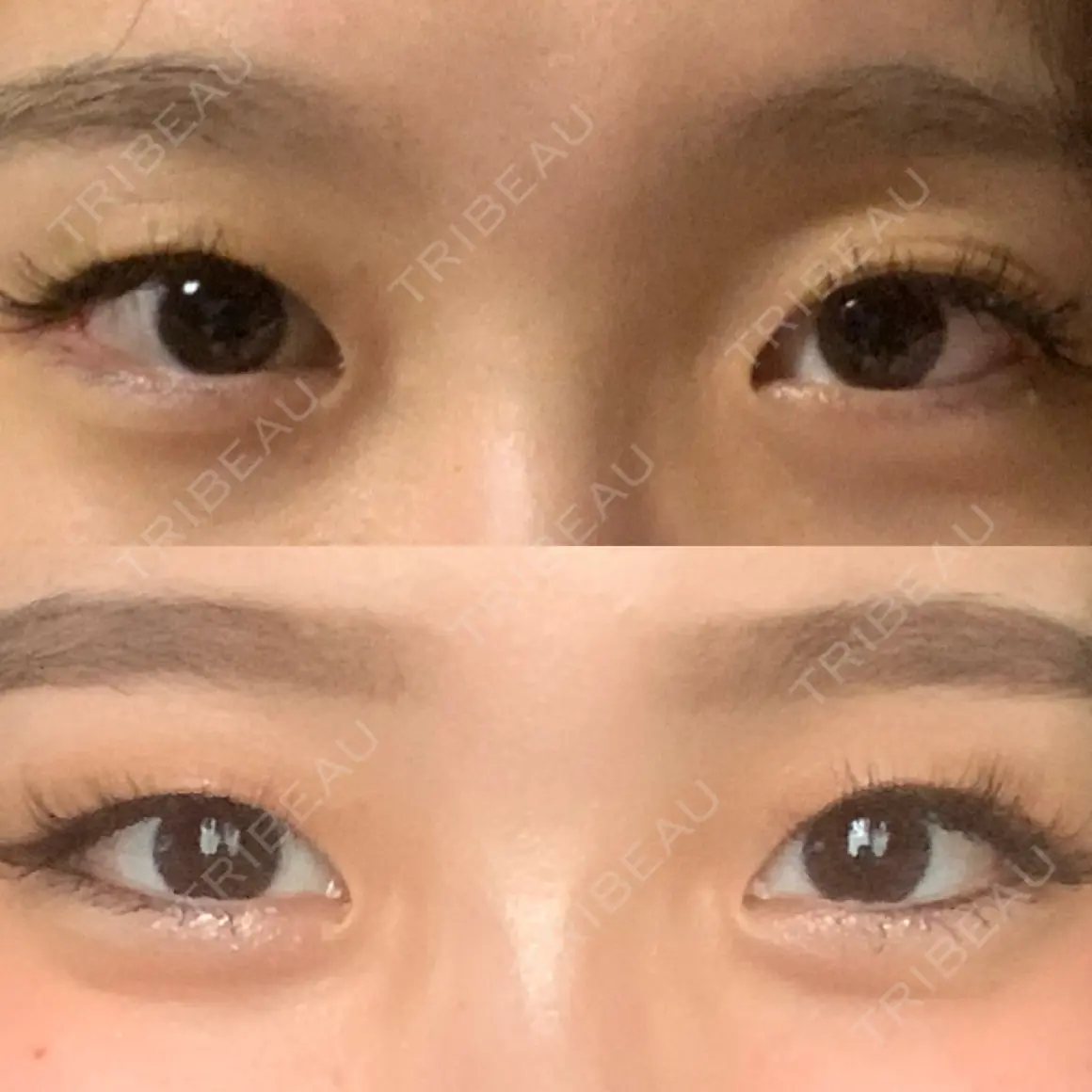 二重埋没 札幌中央形成外科 AFTER