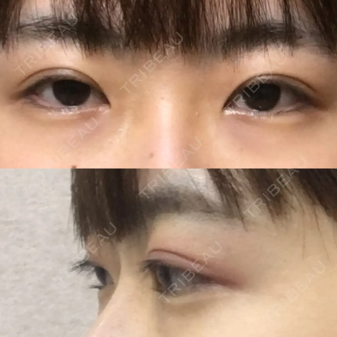 二重埋没 / 目頭切開 / 眼瞼下垂（切開） / タレ目形成・グラマラスライン（切開） / 目元修正 / その他（目元） シナジー整形外科 AFTER