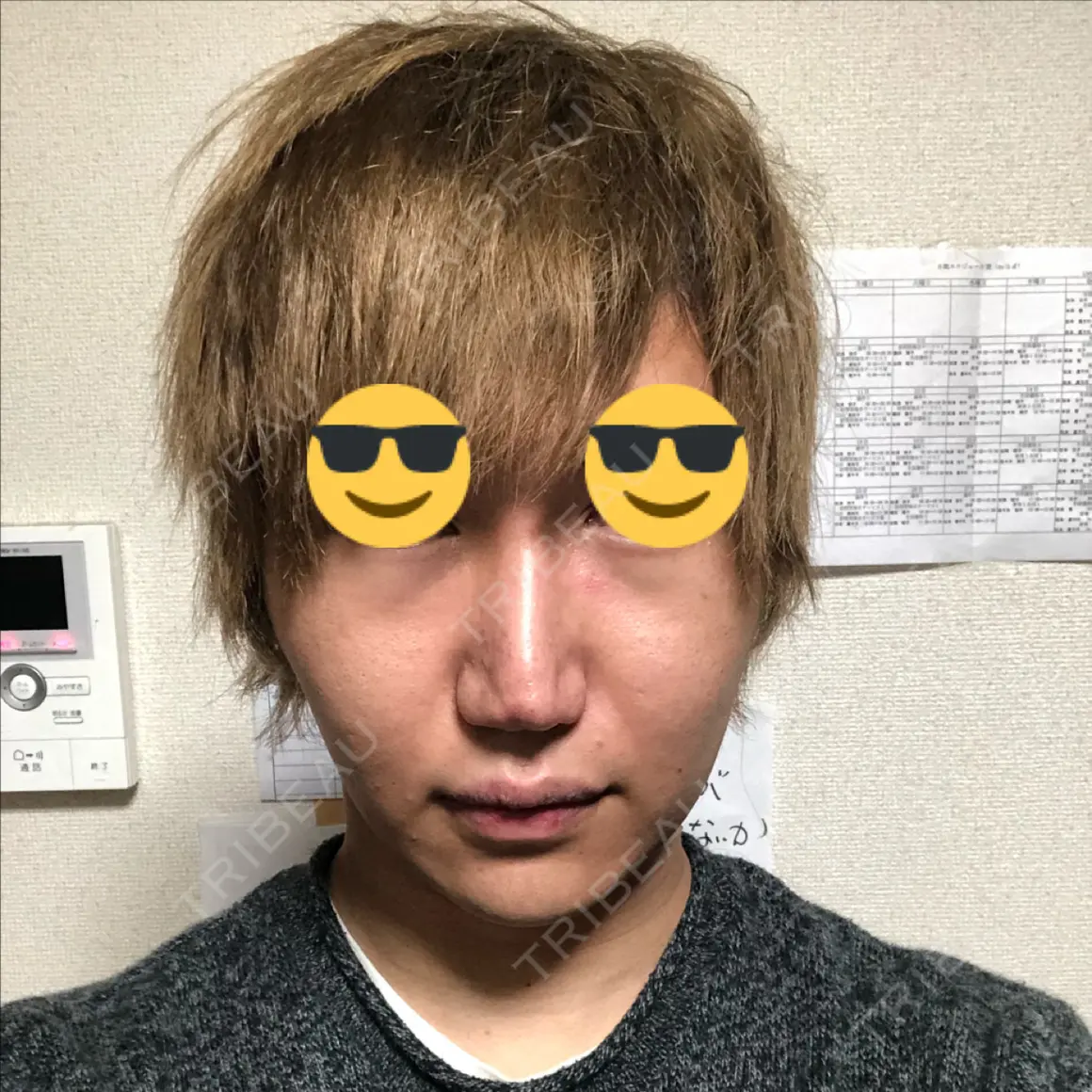 ハイフ（顔） abijouクリニック AFTER