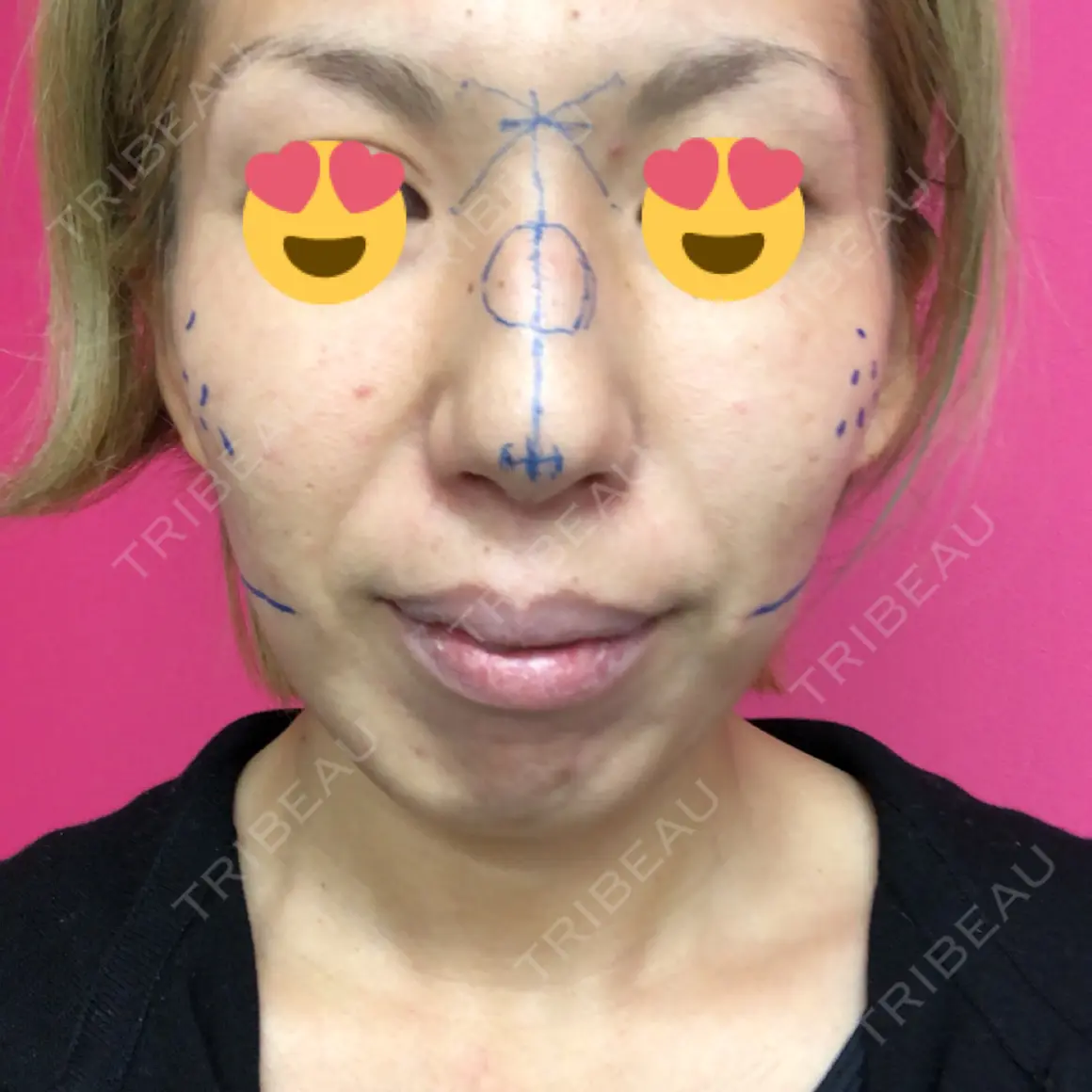 鼻尖形成（切開） / 糸リフト / 軟骨移植 / ワシ鼻修正・ハンプ切除 / ヒアルロン酸注入（あご） グローバルビューティークリニック 大阪院 AFTER