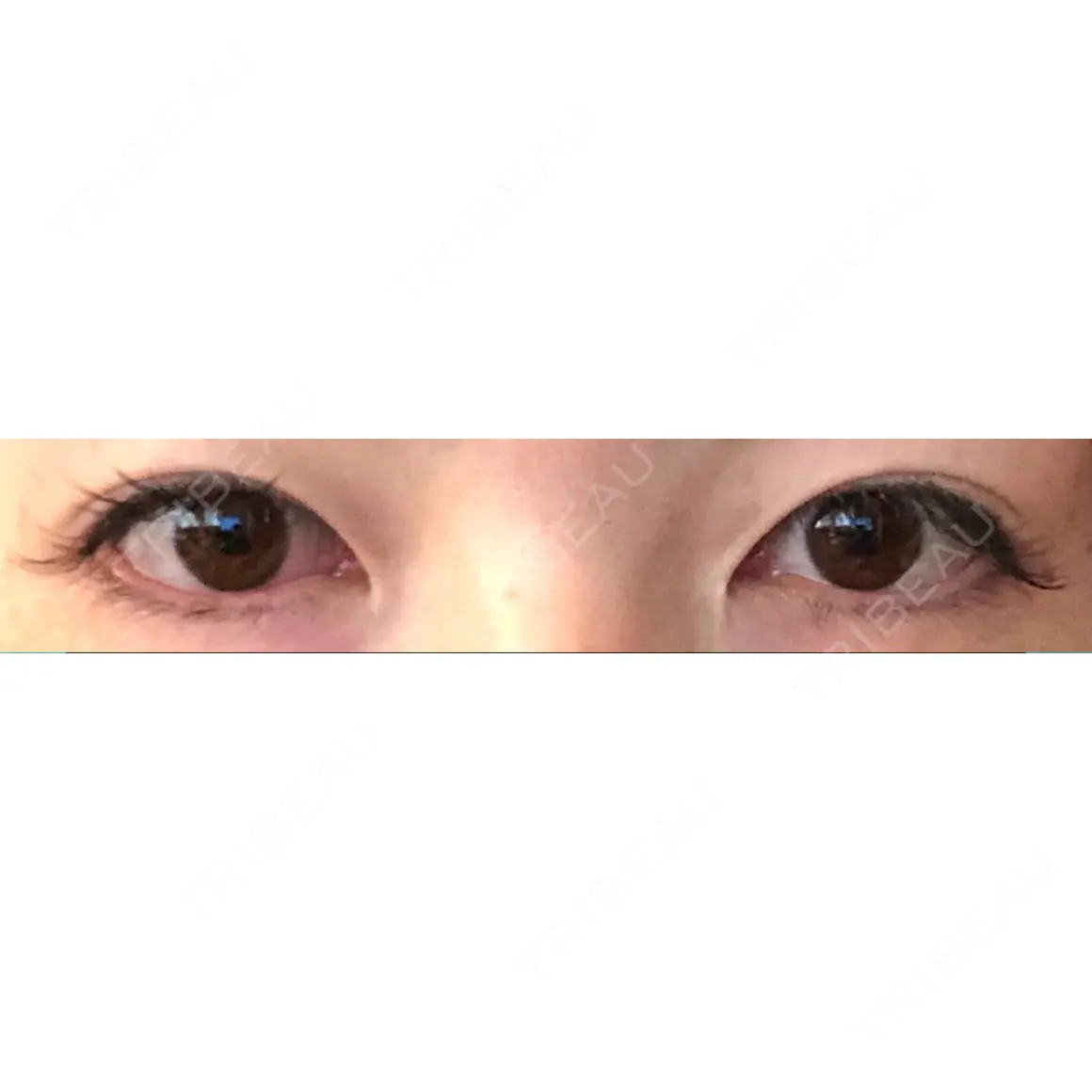 二重埋没 / 目頭切開 / 眼瞼下垂（切開） / 目元修正 / 自然癒着法 POP美容整形クリニック AFTER