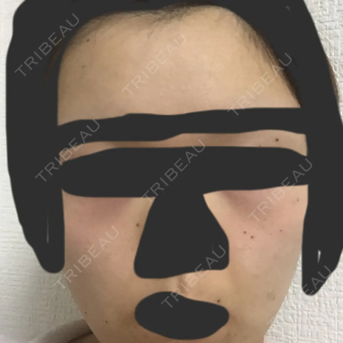 ほくろ・いぼ切除（肌） 高梨医院 皮膚科・美容皮膚科 AFTER