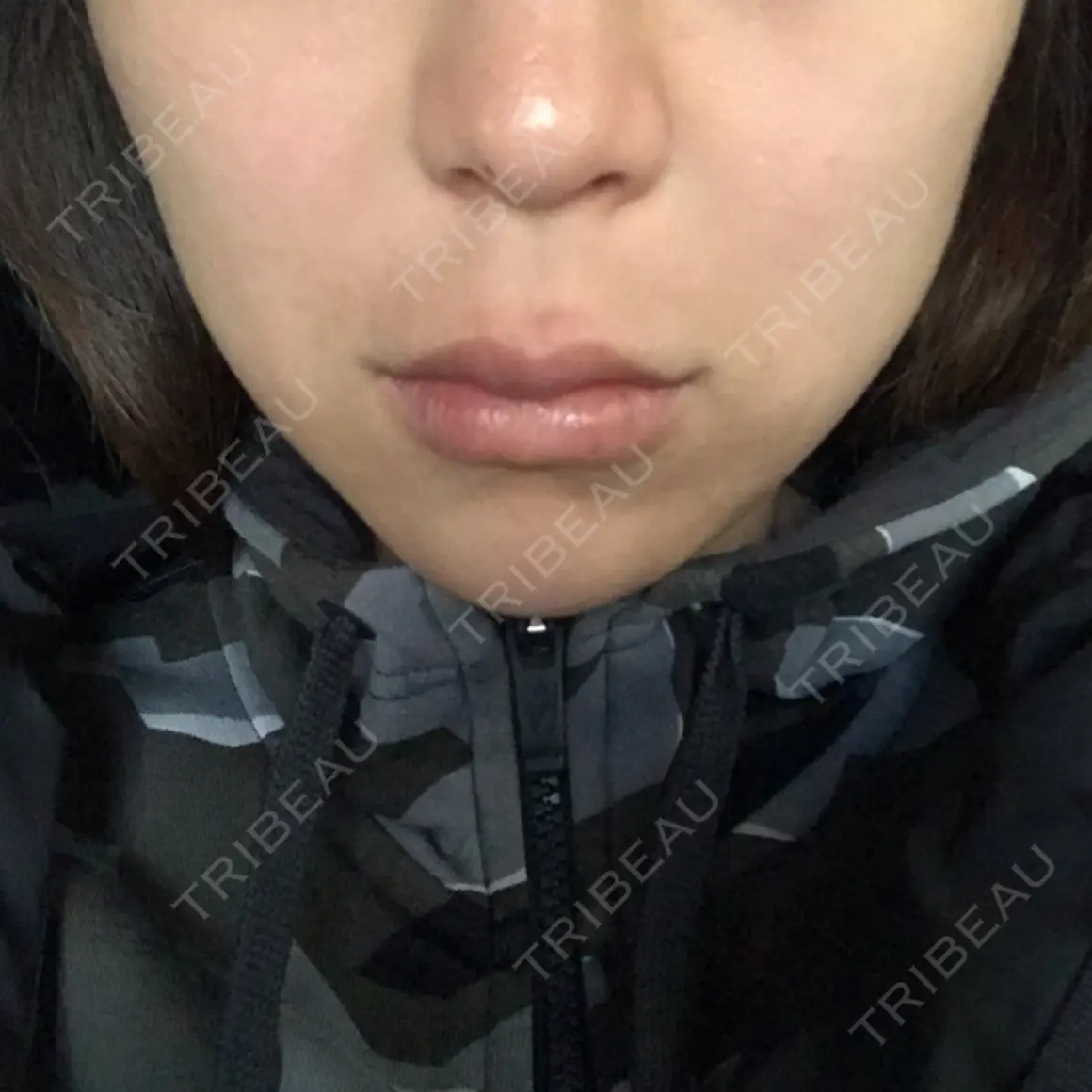 人中短縮 プリモ麻布十番クリニック AFTER