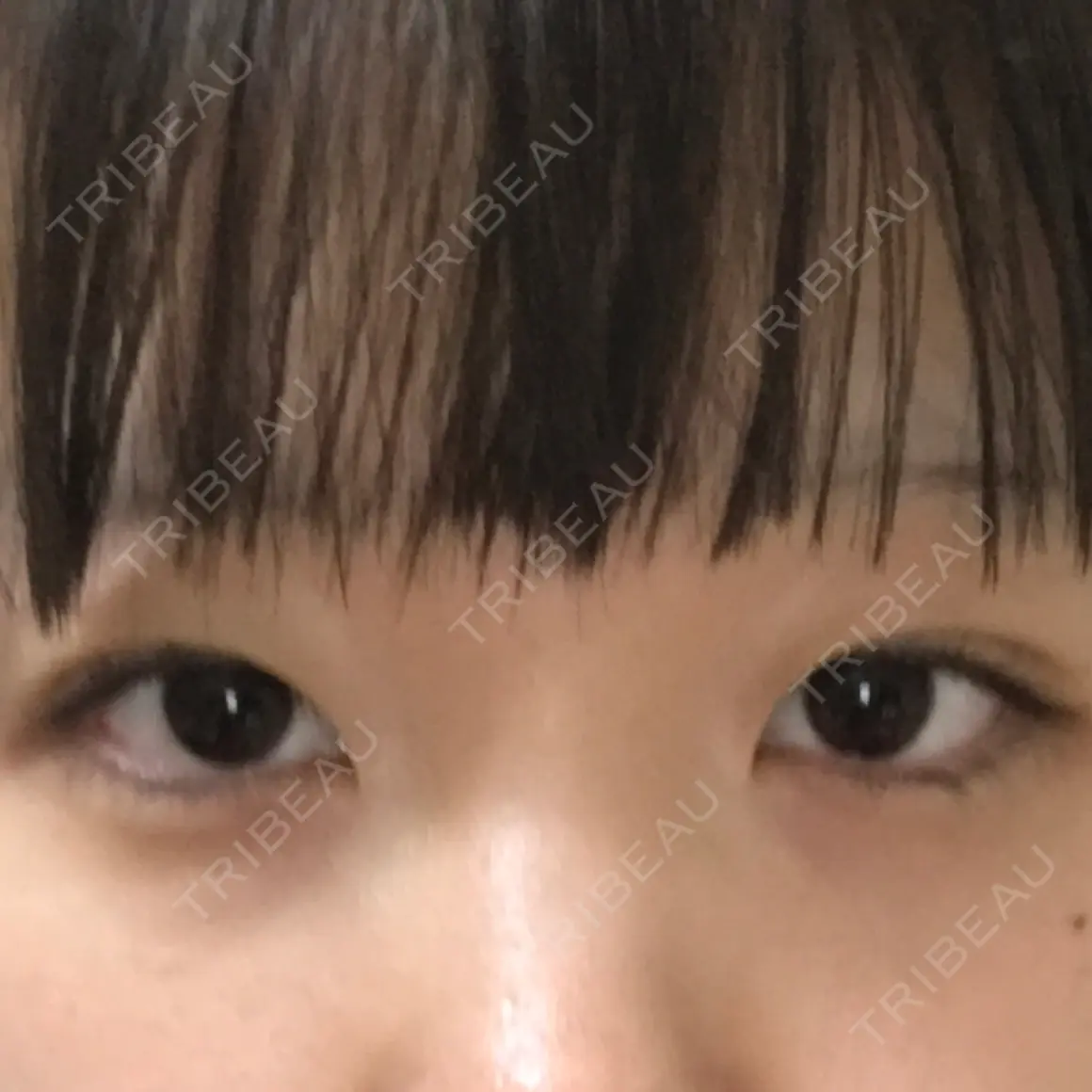 二重埋没 銀座高須クリニック AFTER