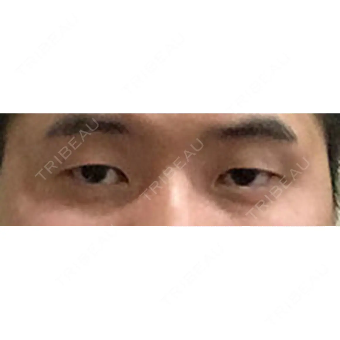 二重埋没 マーブル美容整形外科 AFTER