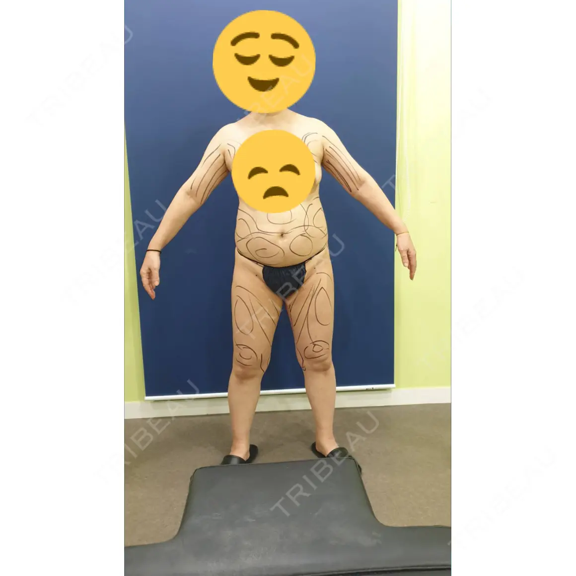 脂肪吸引（お腹） REX整形外科 AFTER