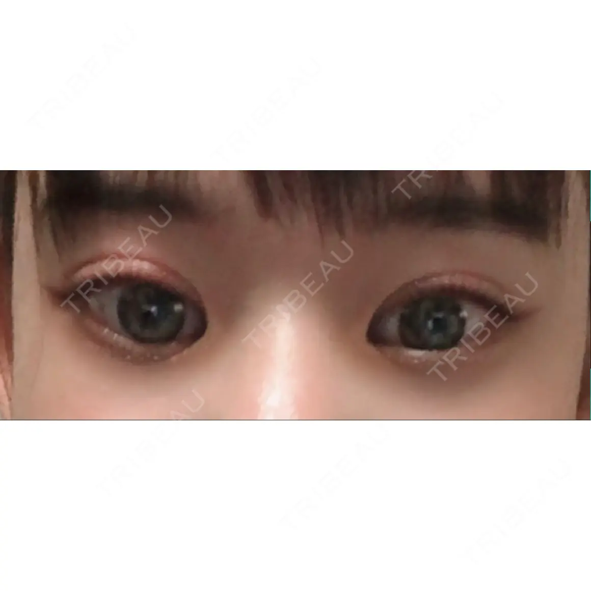 二重切開 / 眼瞼下垂（切開） 新前橋かしま眼科形成外科クリニック AFTER