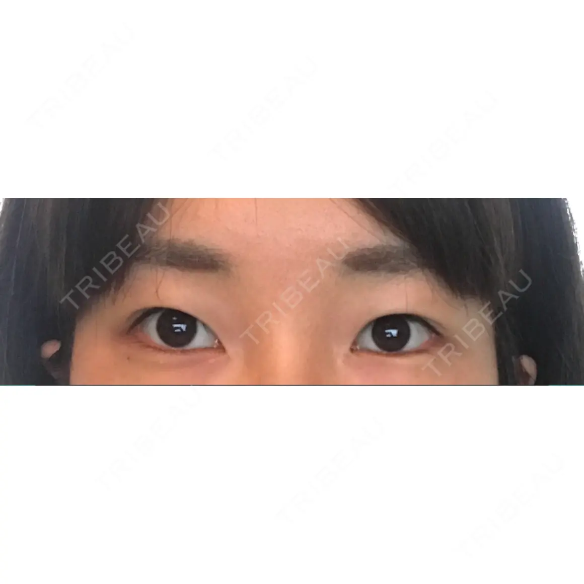 二重切開 銀座高須クリニック AFTER