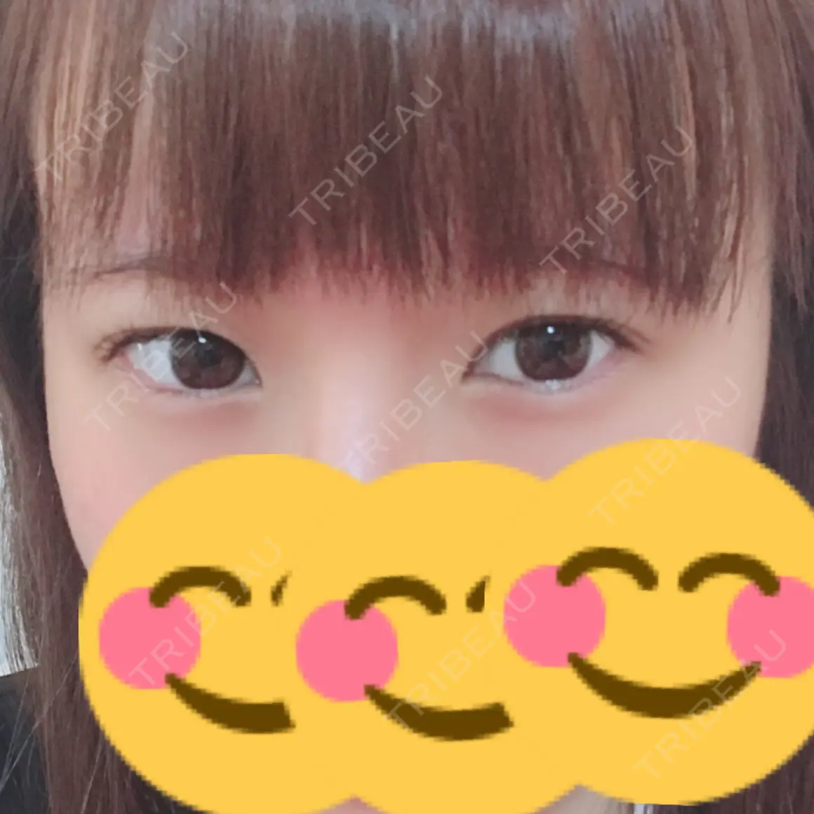 二重切開 / タレ目形成・グラマラスライン（切開） 高須クリニック 名古屋院 AFTER