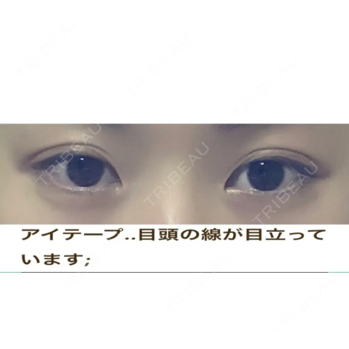 二重埋没 品川美容外科 仙台院 AFTER