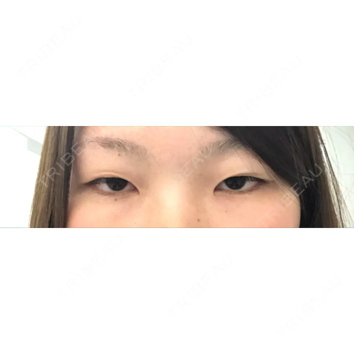 二重切開 / 目頭切開 銀座高須クリニック AFTER