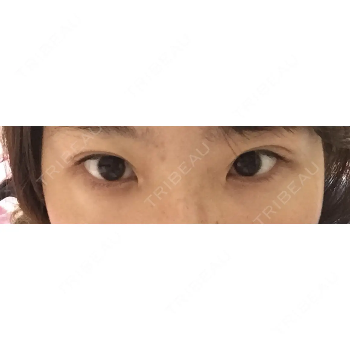 二重切開 高須クリニック 名古屋院 AFTER
