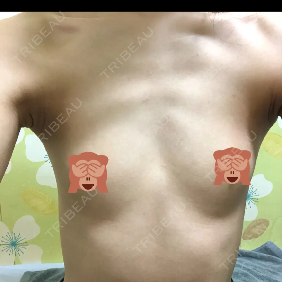 豊胸（シリコンバッグ） マーブル美容整形外科 AFTER