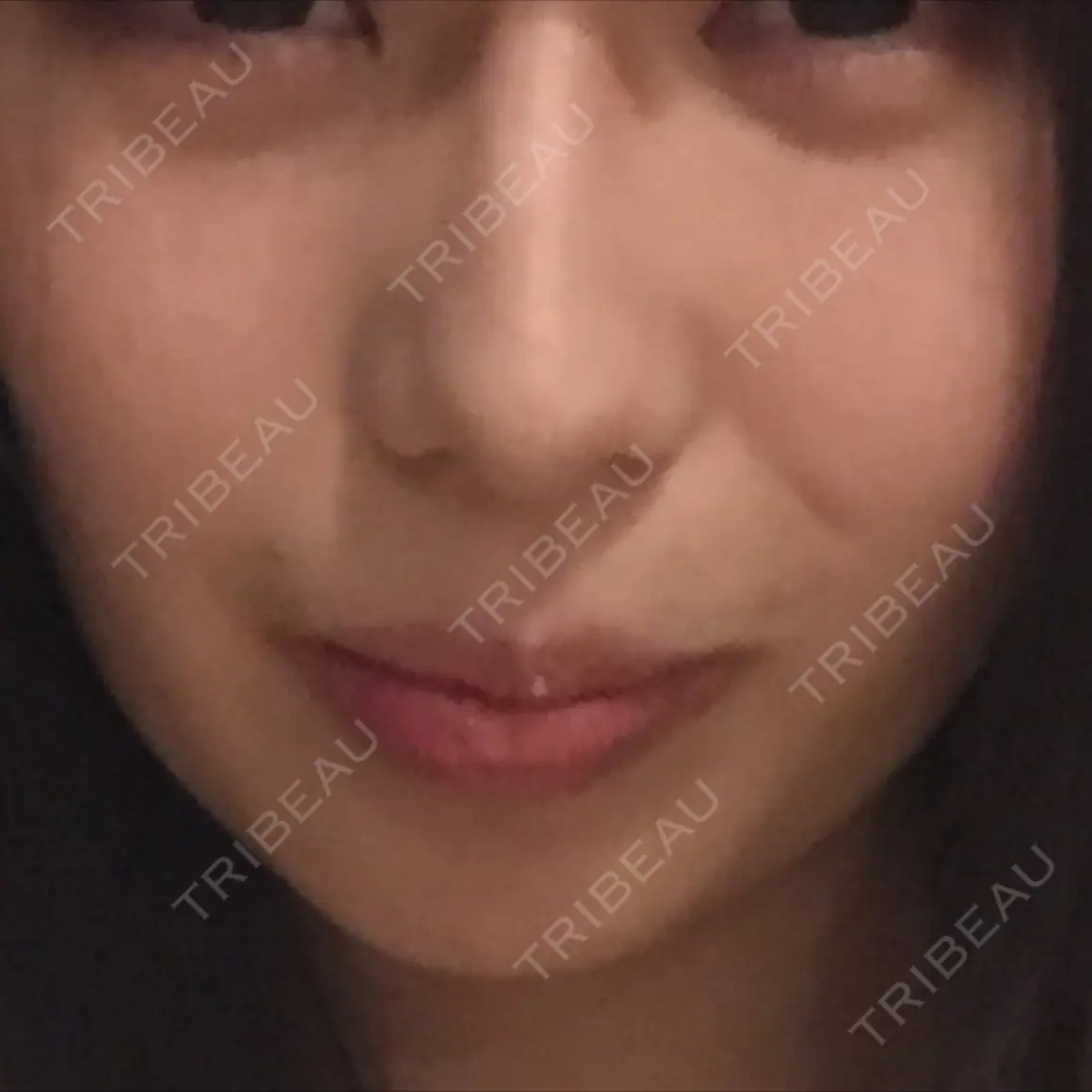 ヒアルロン酸注入（涙袋） / ヒアルロン酸注入（唇） 渋谷美容外科クリニック 池袋院 AFTER