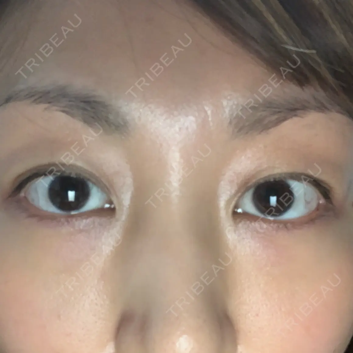 眉下切開 湘南美容クリニック 大阪京橋院 AFTER