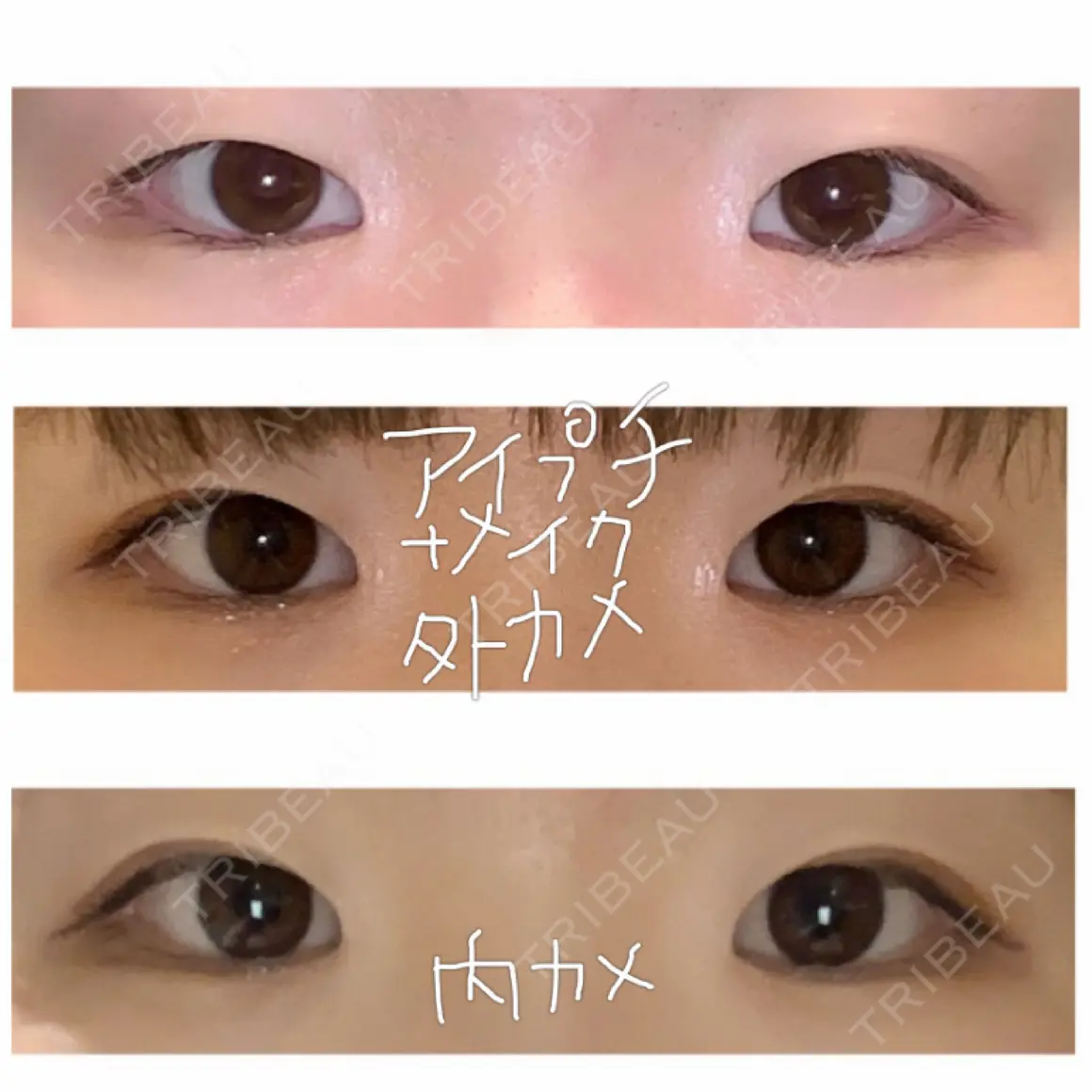 自然癒着法 マーブル美容整形外科 AFTER