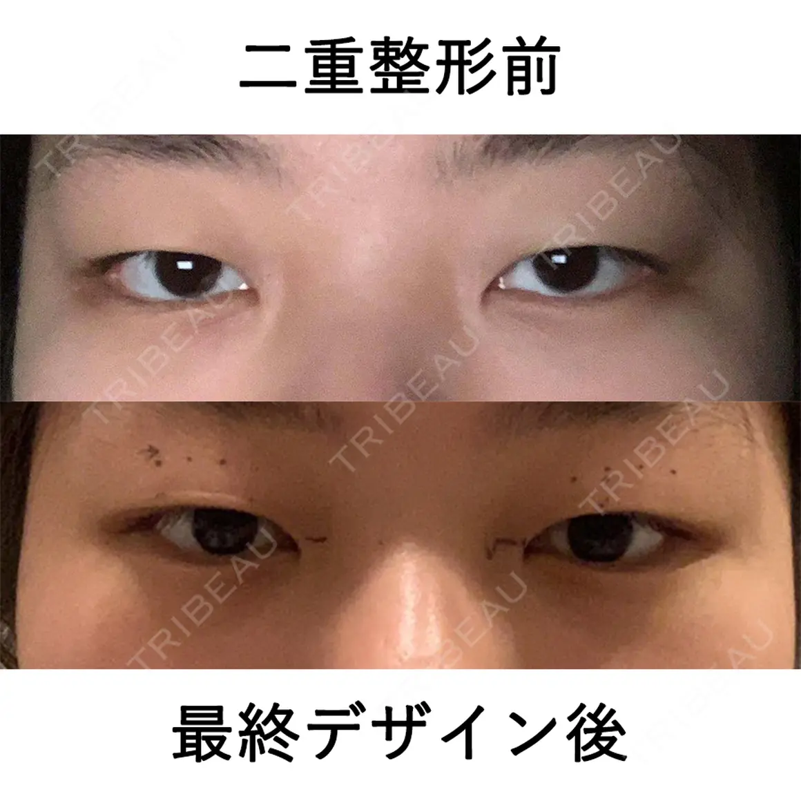 二重埋没 マーブル美容整形外科 AFTER