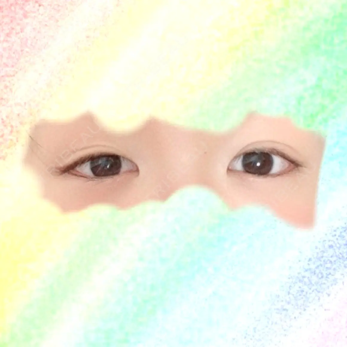 二重埋没 共立美容外科 大宮院 AFTER