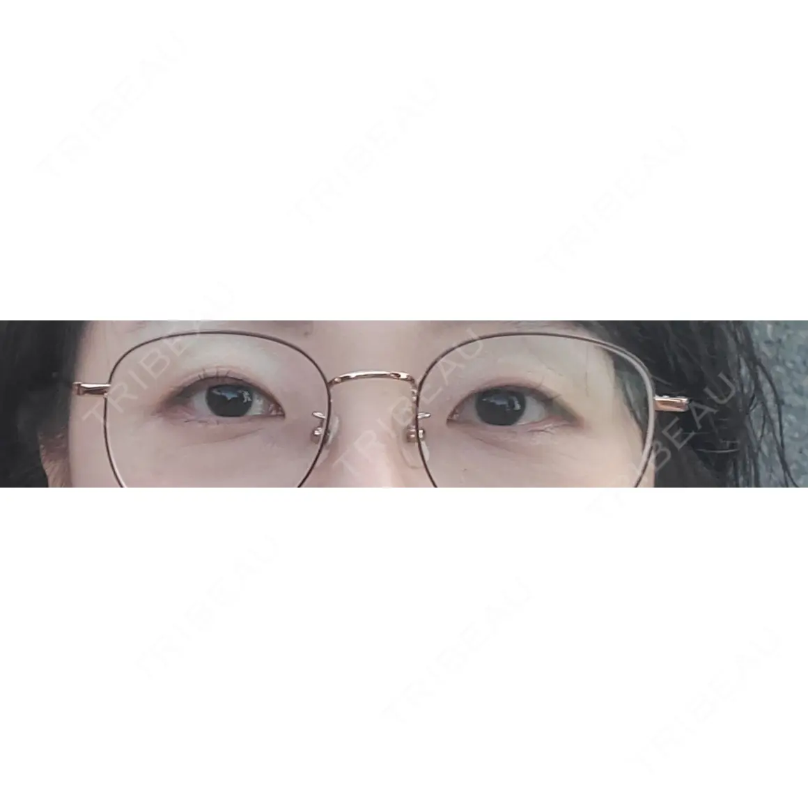 二重切開 ティーズクリニック AFTER