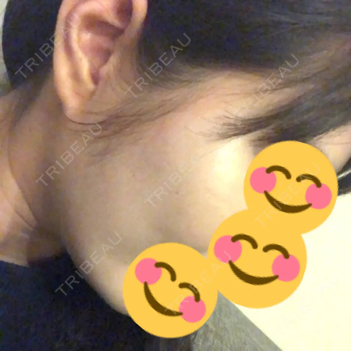 ヒアルロン酸注入（頬） id美容クリニック 銀座院 AFTER