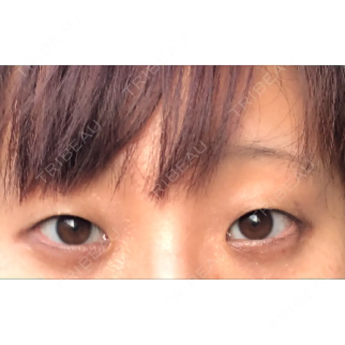 二重埋没 ティーズクリニック AFTER