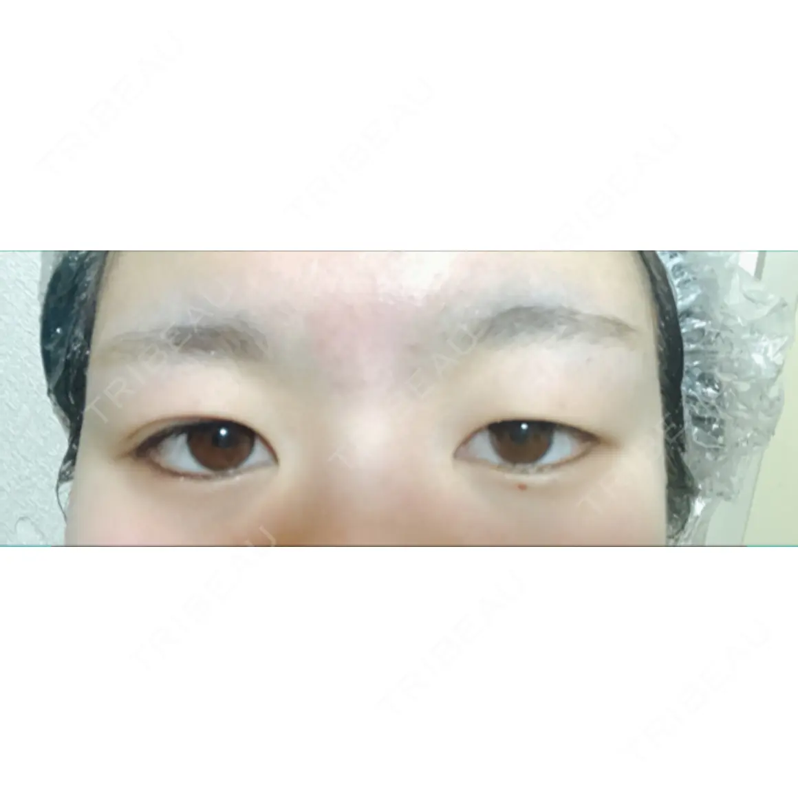 二重埋没 / 眉下切開 湘南美容クリニック 京都院 AFTER