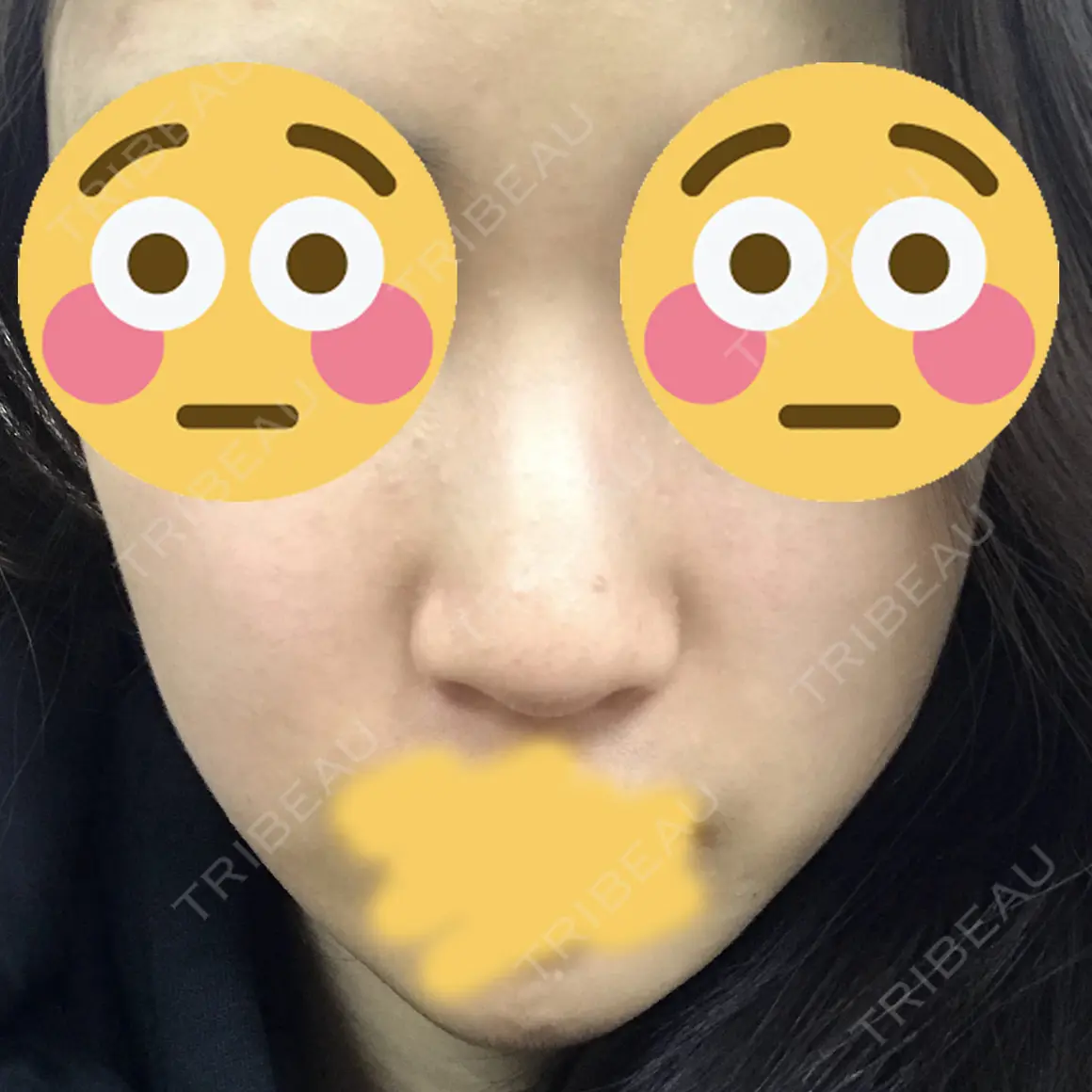 隆鼻術 / 鼻中隔延長（切開） マーブル美容整形外科 AFTER