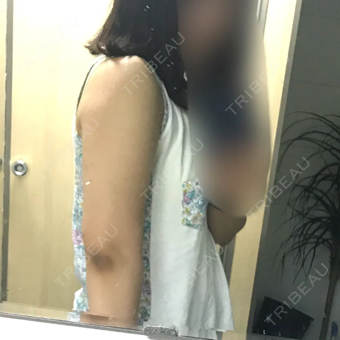 ボトックス（エラ・小顔） / 脂肪溶解注射（顔） / 脂肪溶解注射（二の腕） クリニックA.O. AFTER