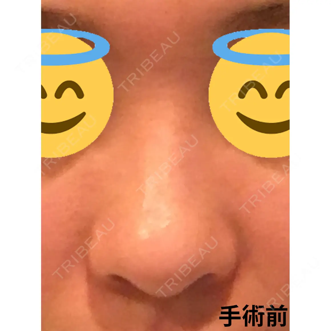 鼻中隔延長（切開） マーブル美容整形外科 AFTER