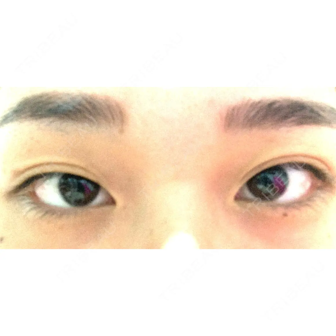 二重切開 蘇春堂形成外科 AFTER