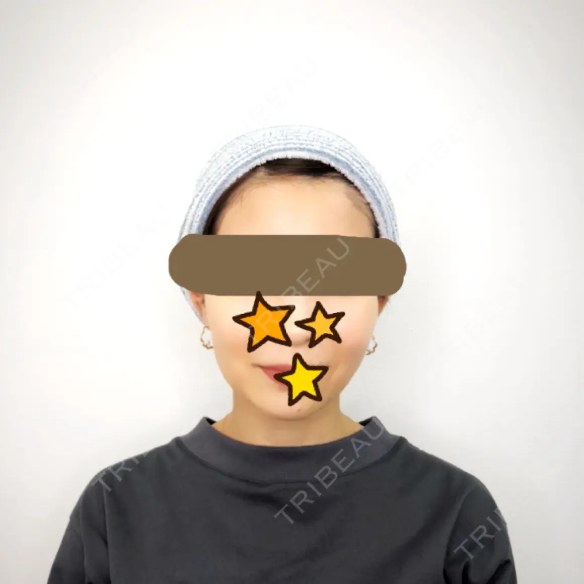 糸リフト 福岡TAクリニック AFTER