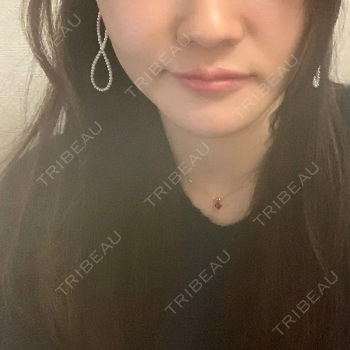 脂肪吸引（顔） / 脂肪吸引（二の腕） / 脂肪吸引（脚） / 豊胸（脂肪注入） / 脂肪注入（輪郭） / その他（ボディ） Mods Clinic（モッズクリニック） 東京院 AFTER