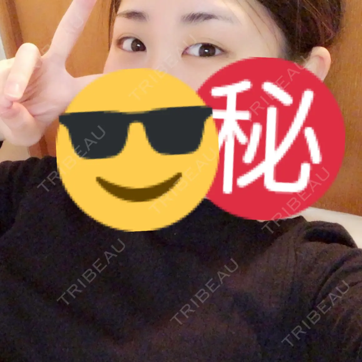 二重埋没 / 上まぶたの脂肪取り TCB東京中央美容外科 郡山院 AFTER