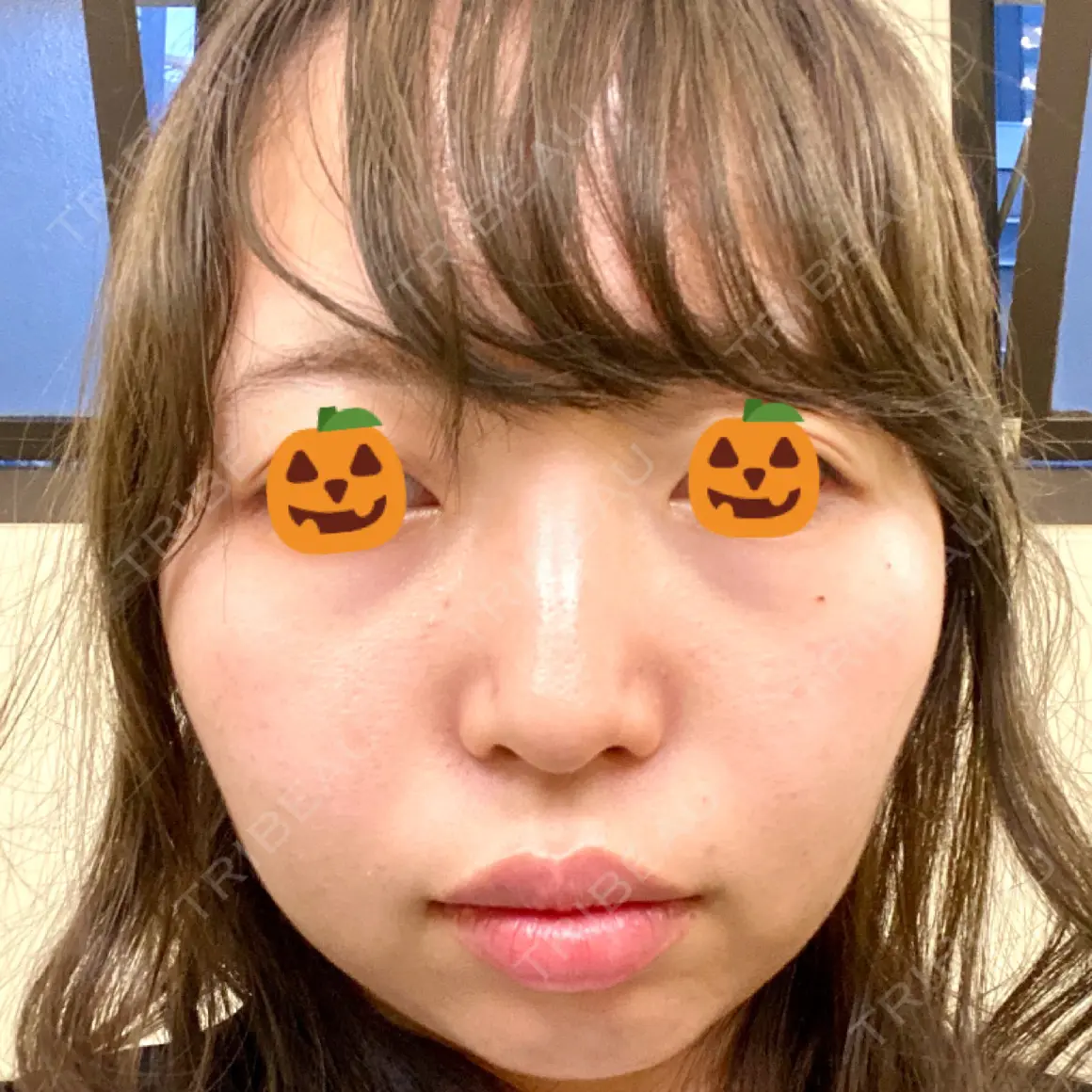 脂肪溶解注射（顔） 品川美容外科 新宿院（※品川スキンクリニック提携） AFTER