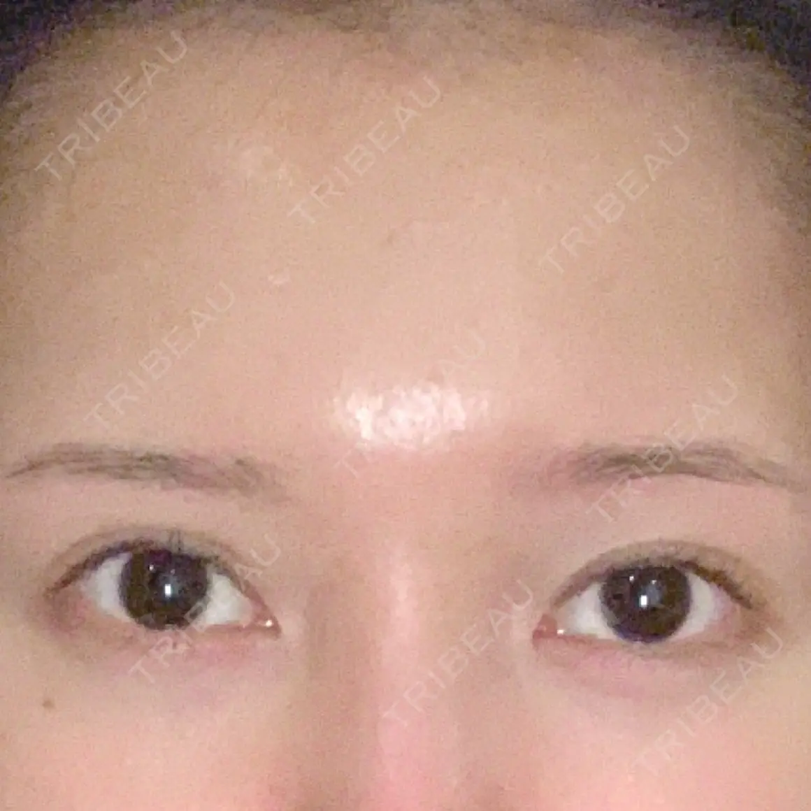 二重埋没 / 目元修正 BIANCA銀座 AFTER