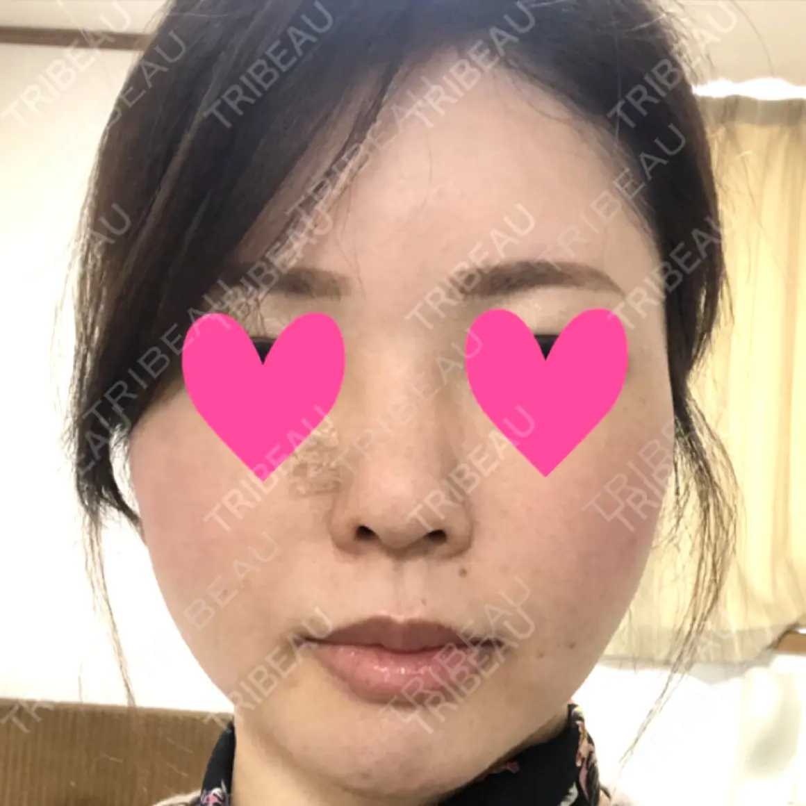 脂肪注入（輪郭） メガクリニック AFTER