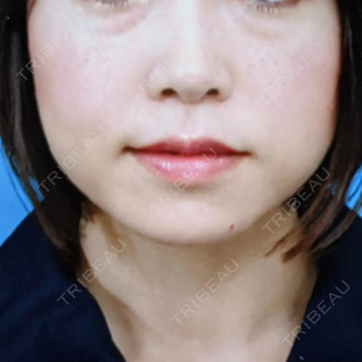 ボトックス（エラ・小顔） 品川美容外科 福岡院 AFTER