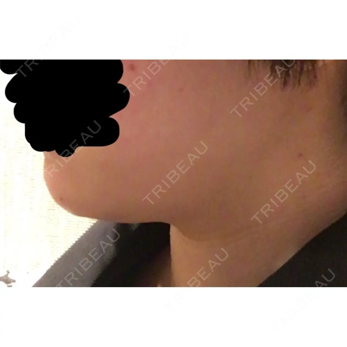 脂肪溶解注射（顔） 聖心美容クリニック 六本木院 AFTER