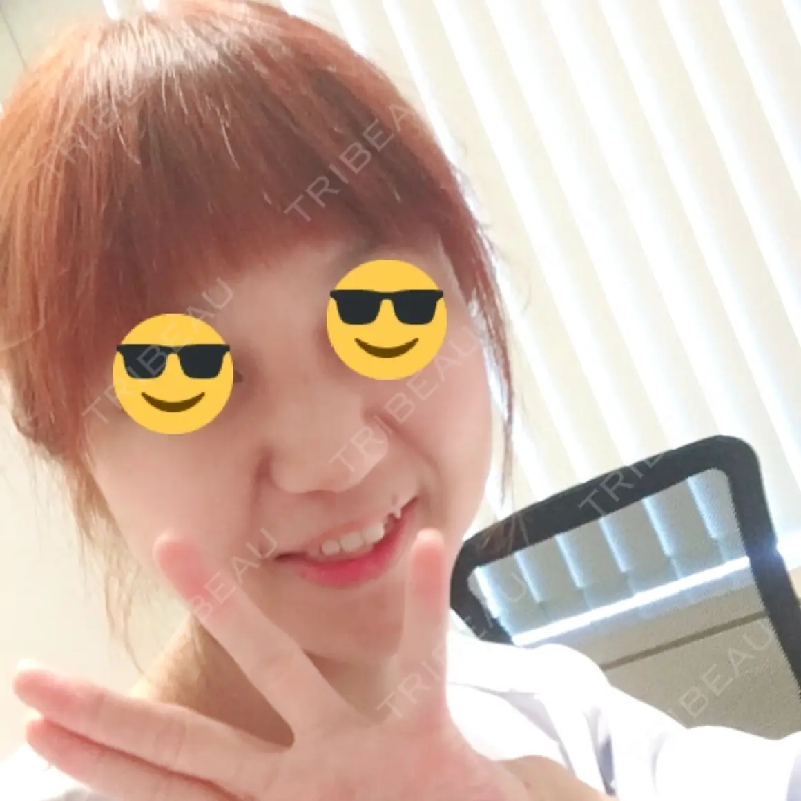 鼻尖形成（切開） / 鼻中隔延長（切開） / 骨切幅寄せ / 鼻尖縮小 ヴェリテクリニック 名古屋院 AFTER