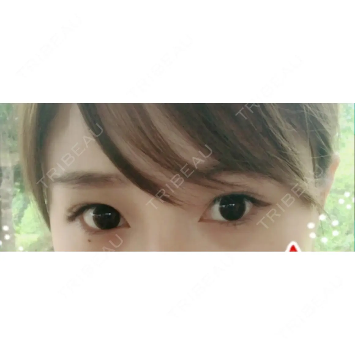 二重埋没 / 上まぶたの脂肪取り 共立美容外科 柏院 AFTER