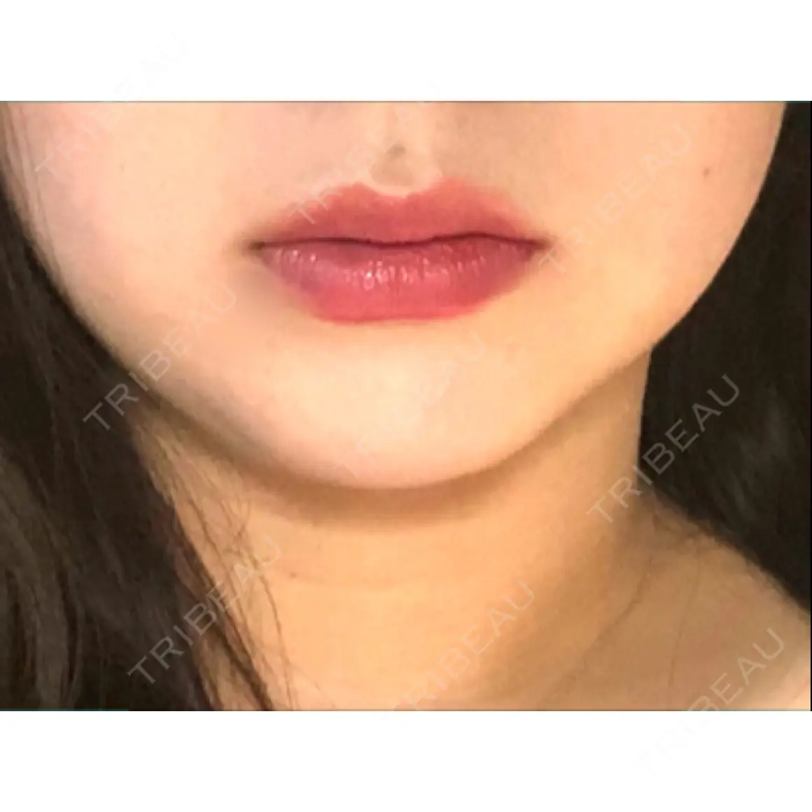 ボトックス（エラ・小顔） / 脂肪溶解注射（顔） / ヒアルロン酸注入（唇） / ボトックス（口角） id美容クリニック 銀座院 AFTER