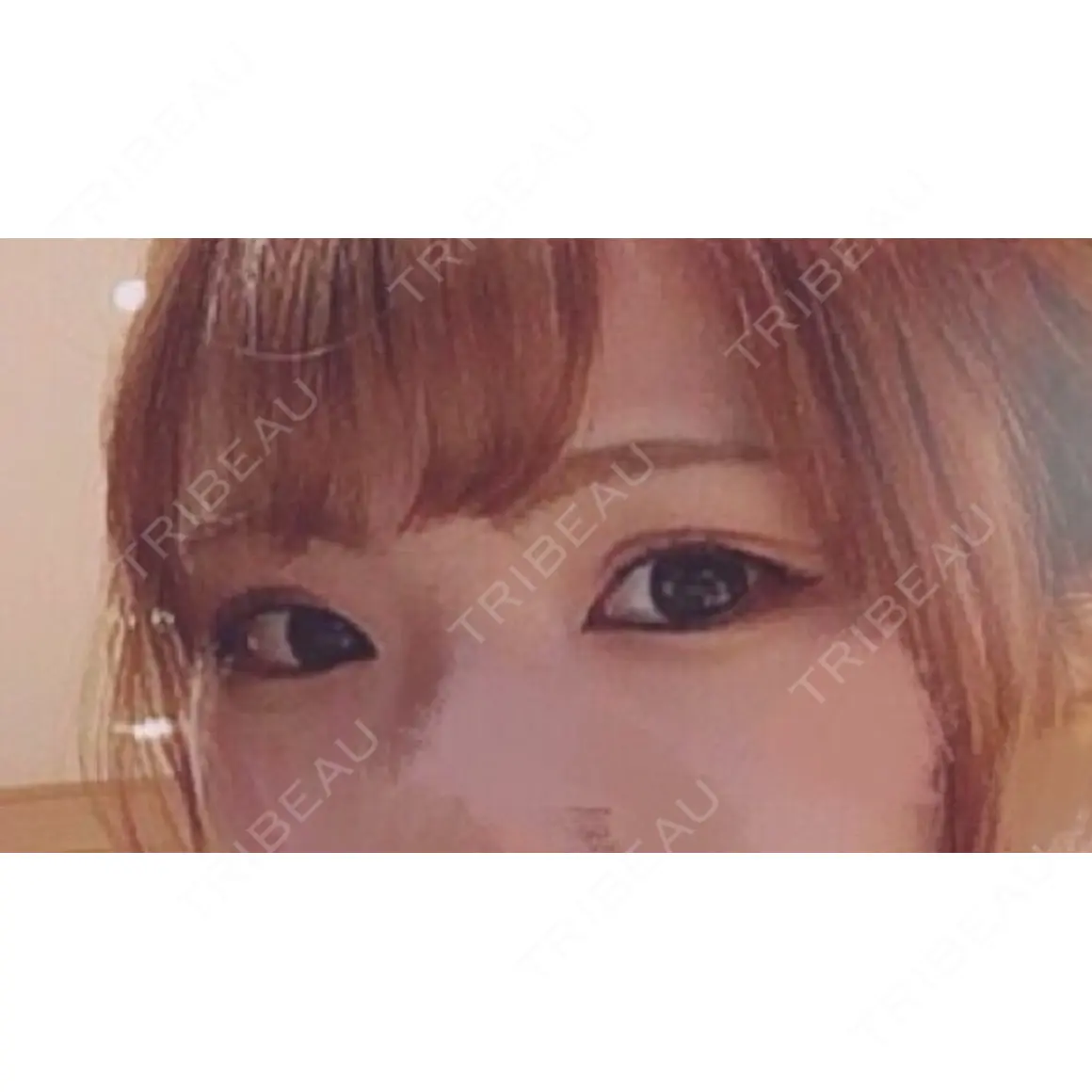 二重切開 / 目頭切開 / 眼瞼下垂（切開） / 目尻切開 / 上まぶたたるみ取り / ヒアルロン酸注入（涙袋） ジュエリー美容外科 AFTER